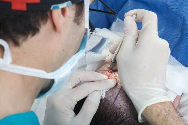 השתלת שיער תהליך החלמה