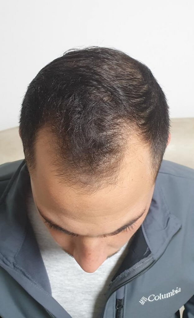 התקרחות גברית