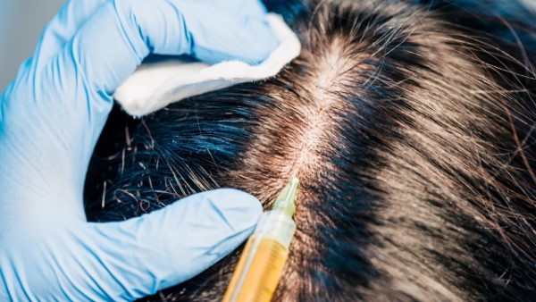 השתלת שיער נשים
