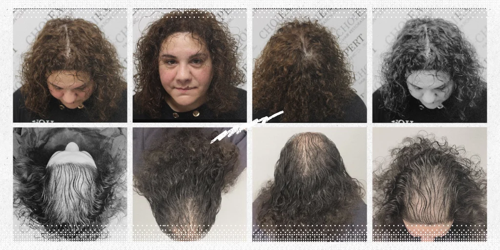 השתלת שיער לנשים