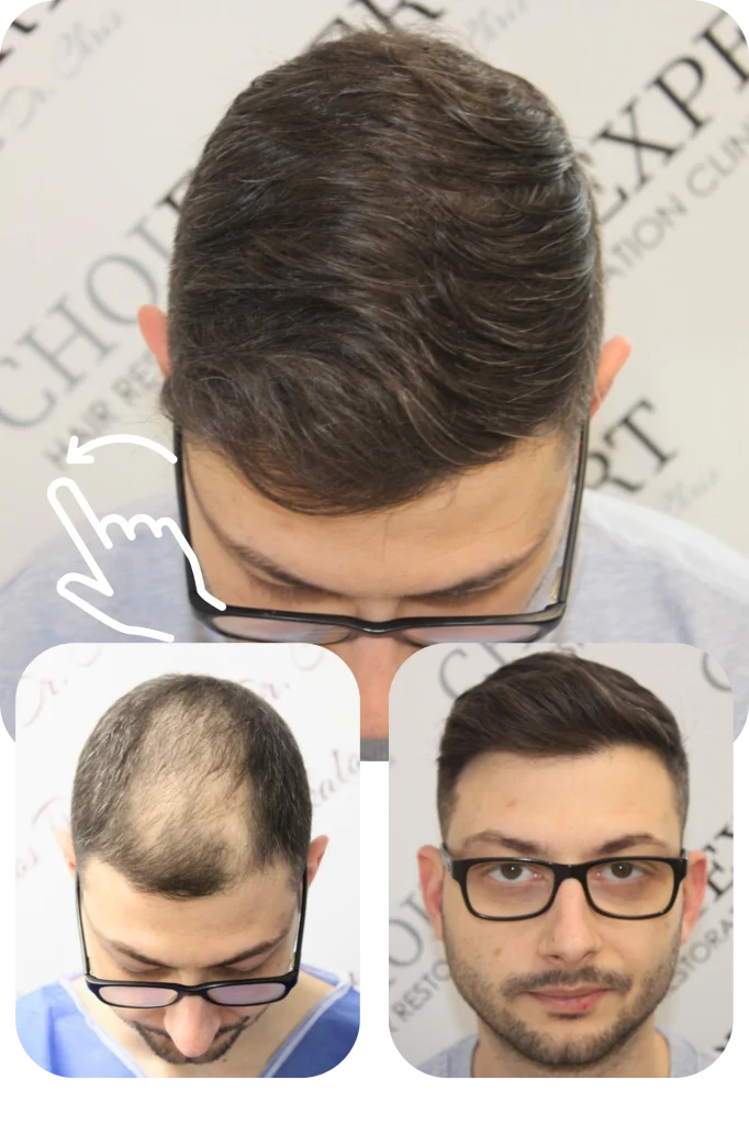 השתלת שיער ביוון