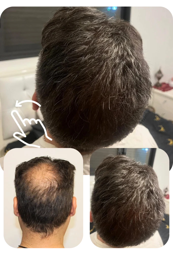 השתלת שיער בכתר