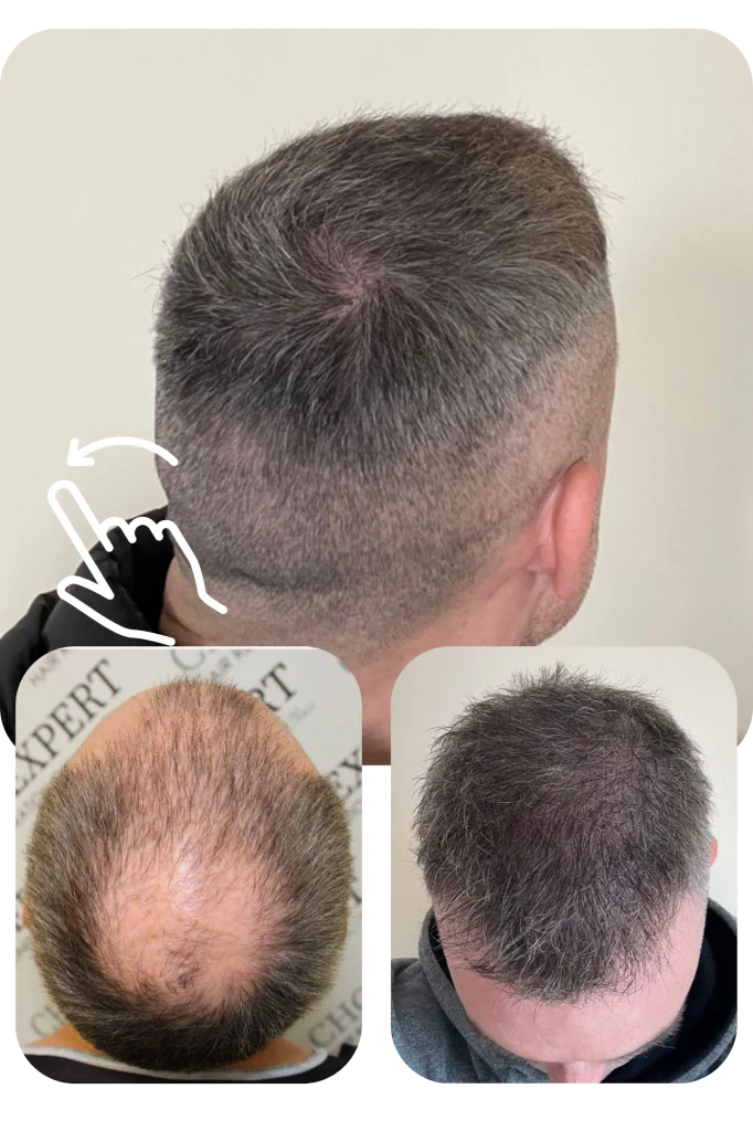 השתלת שיער כתר (Crown) קודקוד CHOIEXPERT ד"ר כריס