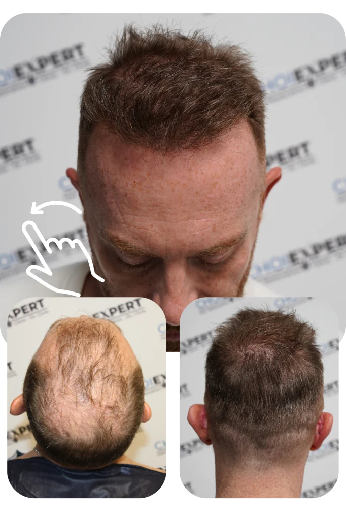 לפני אחרי השתלת שיער CHOIEXPERT