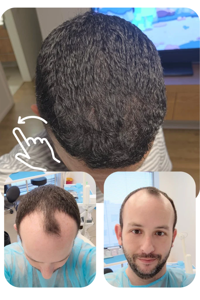 השתלת שיער ביוון