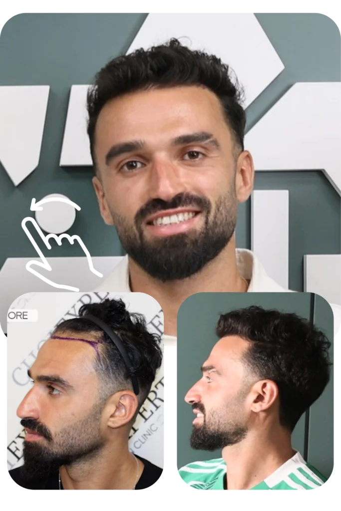 מיכאל אוחנה השתלת שיער ד"ר כריס