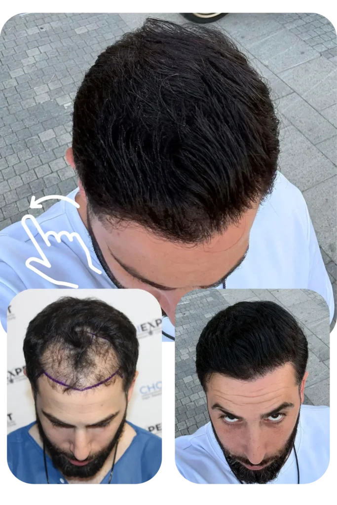 השתלת שיער בארץ